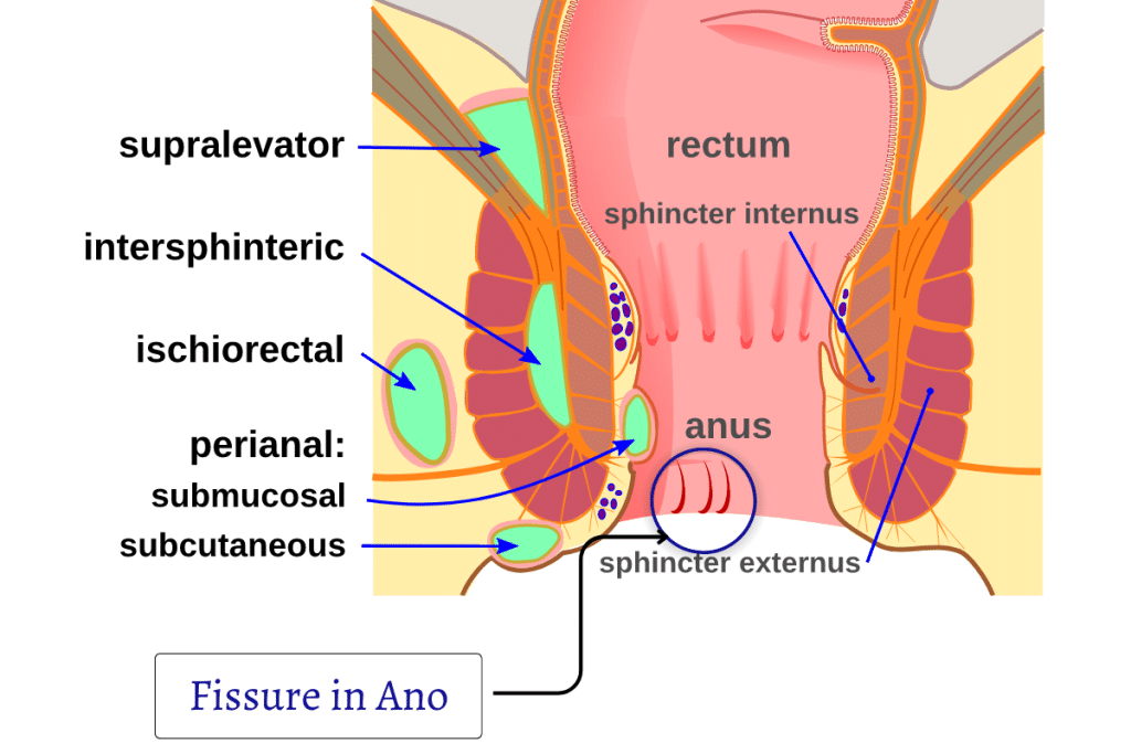 Fissure in Ano Surgery (Anal Fissure Surgery in Mumbai)