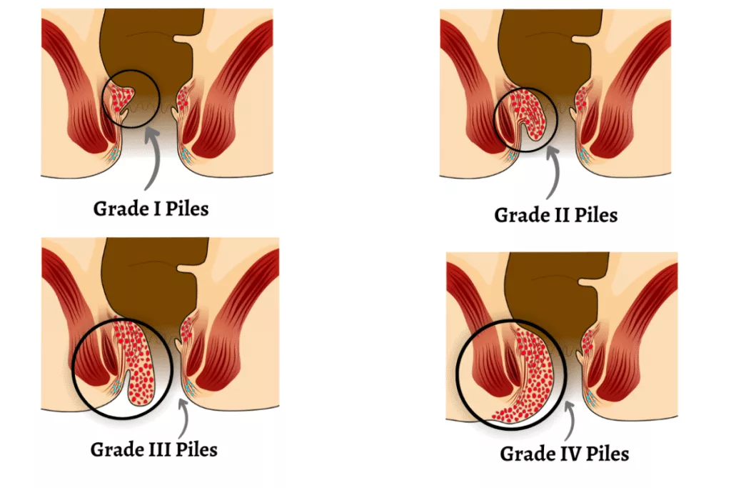 Piles (Haemorrhoids) Surgery in Mumbai - Dr Pradeep Shriyan