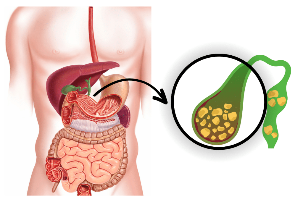 Laparoscopic cholecystectomy (Gall bladder stone removal) surgery in Mumbai