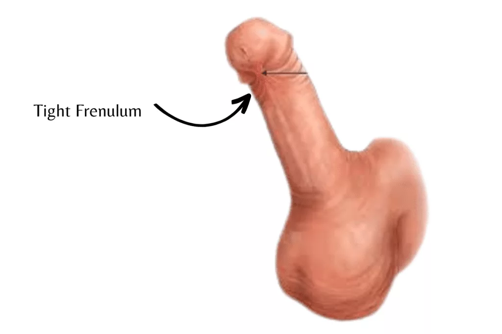 Short Frenulum treatment in Mumbai