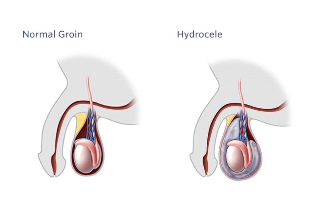 Hydrocele treatment specialist in Mumbai suburban