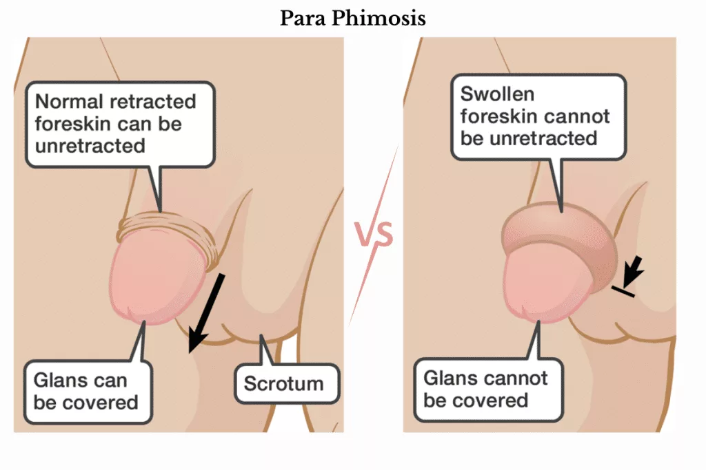 Para-phimosis treatment specialist in Mumbai Suburban