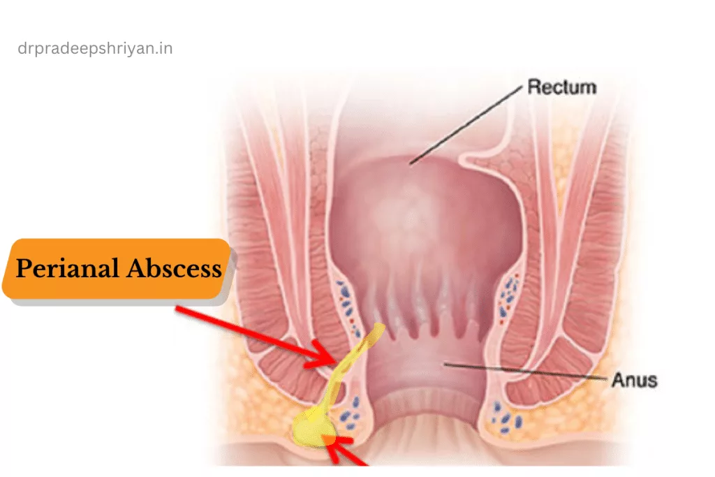 Perianal Abscess treatment Specialist in Mumbai suburban