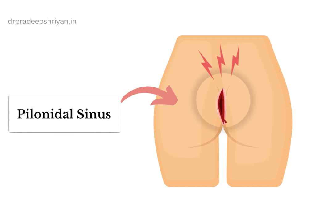 Pilonidal Sinus Treatment Specialist in Goregaon Mumbai Suburban