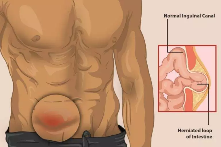 Hernia Repair in Mumbai