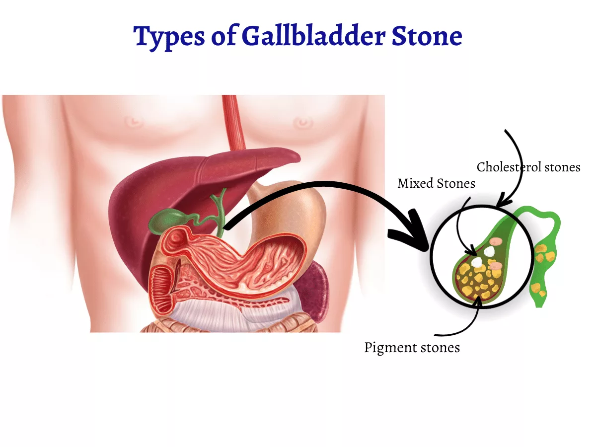 Laparoscopic gallbladder stone surgeon in Mumbai
