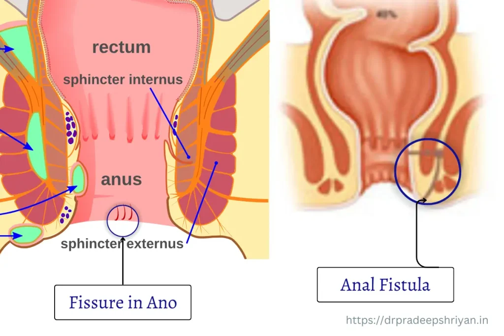 Fissures in Ano and Anal Fistulas difference and Treatment