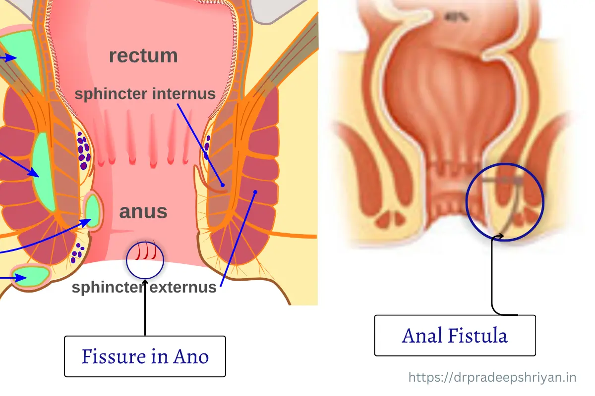 Fissure in ano vs Anal Fistula shown in graphical image where place of anal fissures is shown and place of anal fistula is shown.