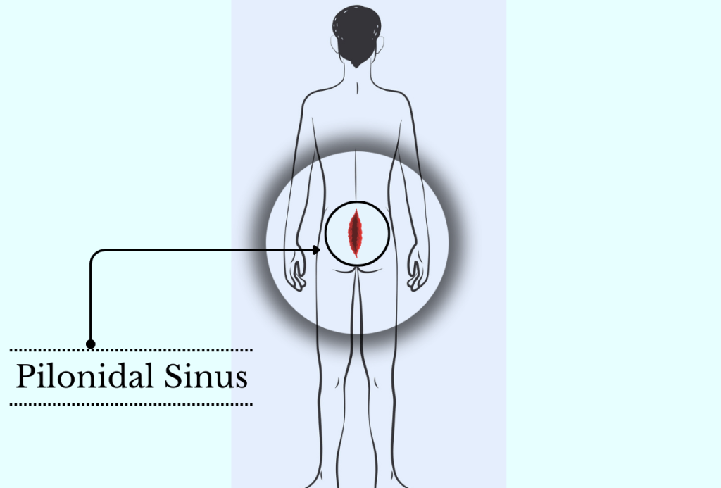 Pilonidal Sinus treatment Mumbai