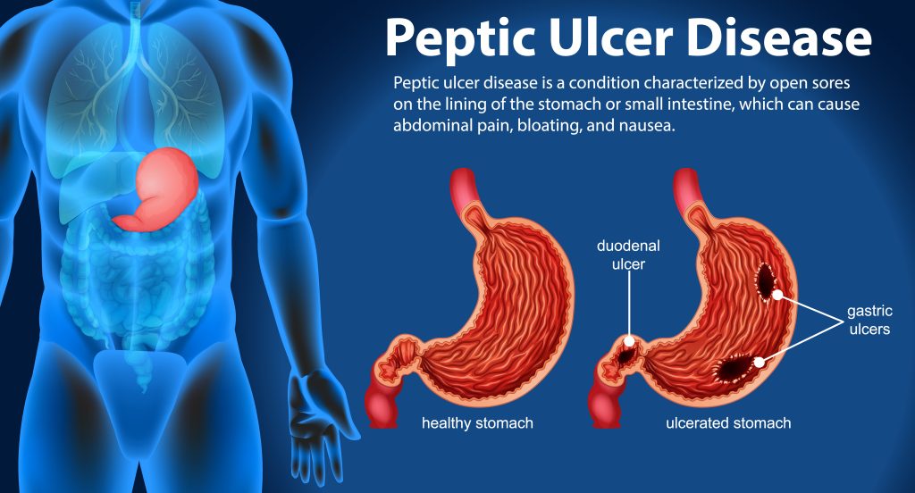 Peptic Ulcer Treatment in Mumbai