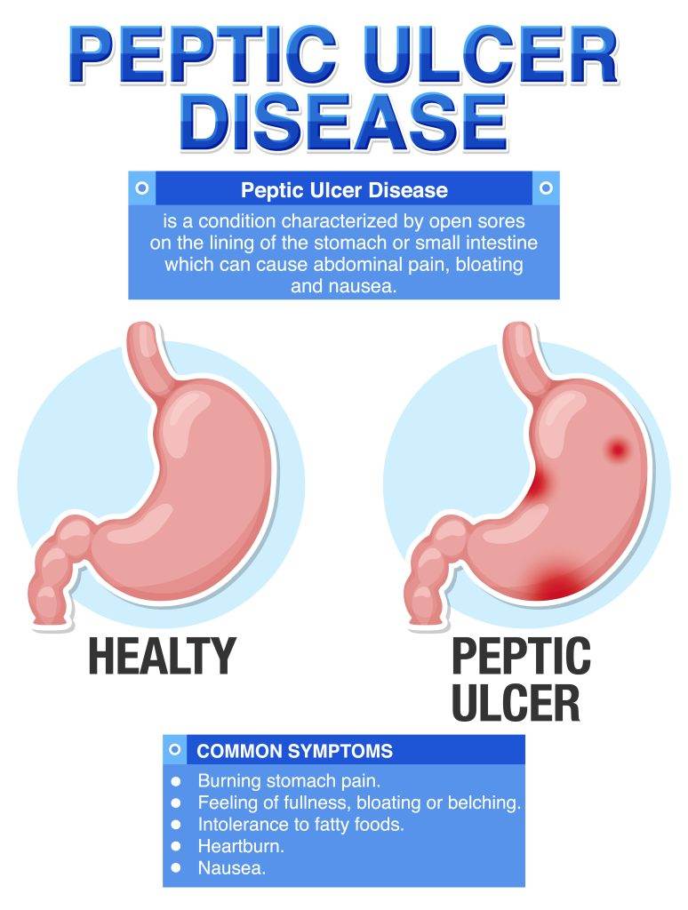 Peptic Ulcer disease and treatment