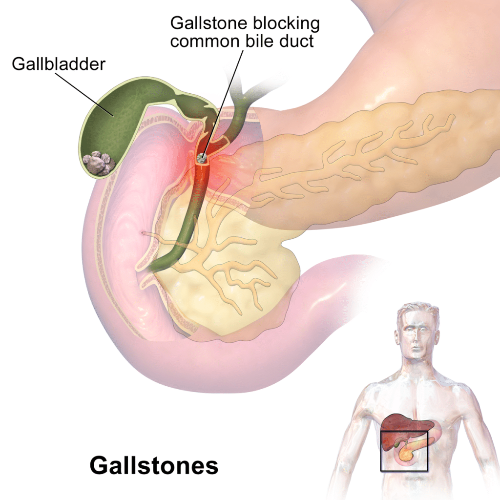 Gallbladder stone treatment Malad