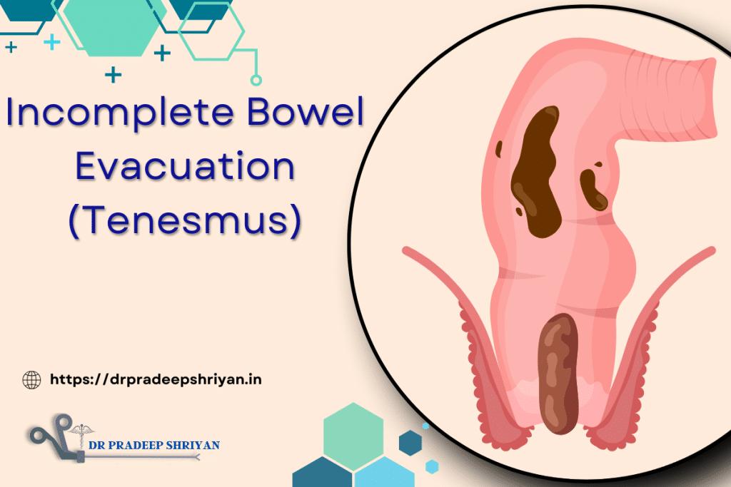 Incomplete Bowel Evacuation Treatment Tenesmus