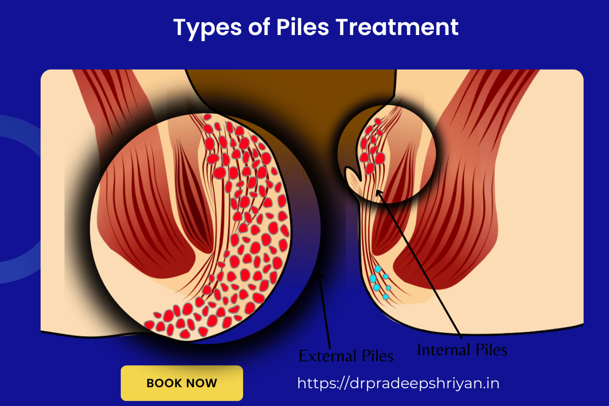 Non Inflamed Pile Piles Treatment in Goregaon, Mumbai - Dr Pradeep Shriyan π©Ίπ